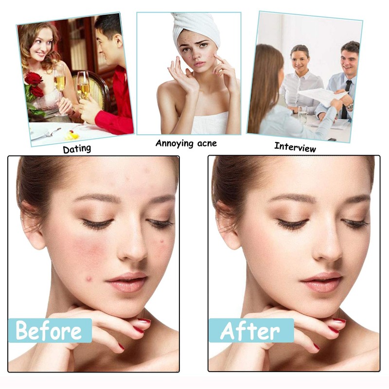 GeekerChip 252 pimple patch, invisible pimple patches for face, acne