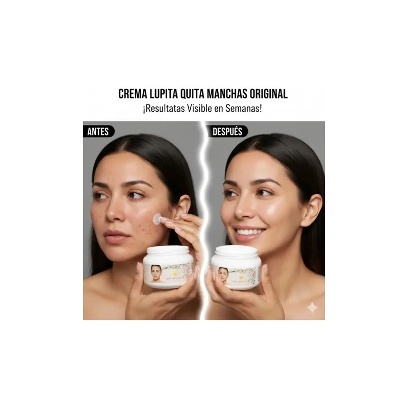 Crema Lupita Original Facial Acantosis Acne Anti Manchas Ros