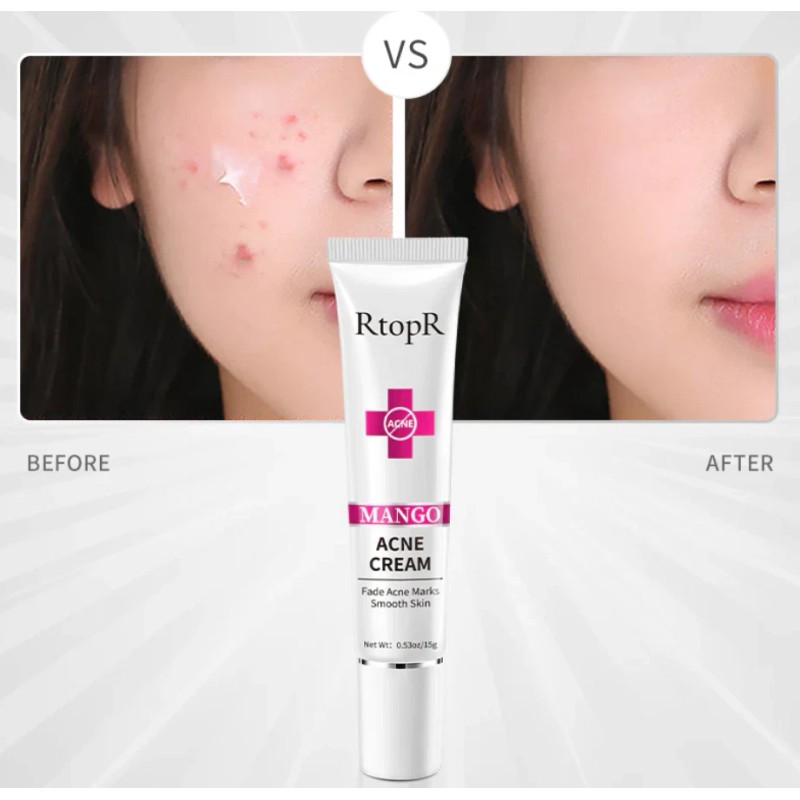 RtopR 3 Cream For Fading Acne Scars Smooth Clear Dark