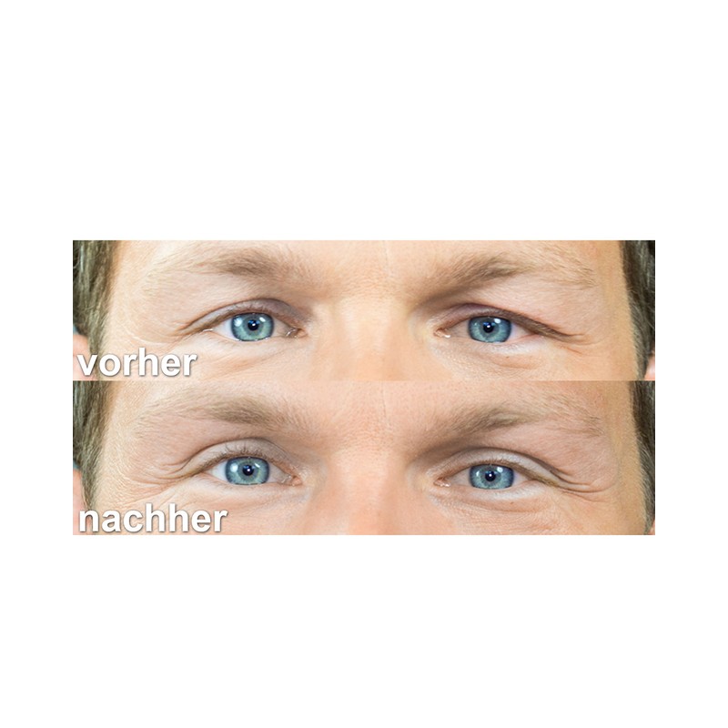 Schlepflid Tape® "pretty size" (M) eyelid lift without surgery [240