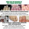 Nature-Upgraded Kreain Multi-Purpose Nail Repair, Nail Solution for Discolored and