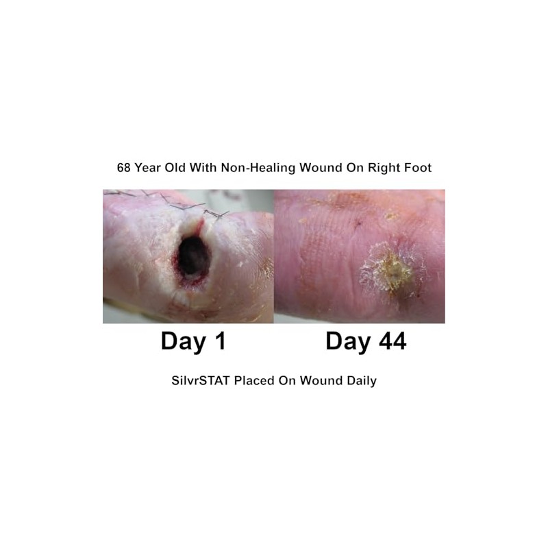 SilvrSTAT Antibacterial Wound Dressing Gel 3 OZ