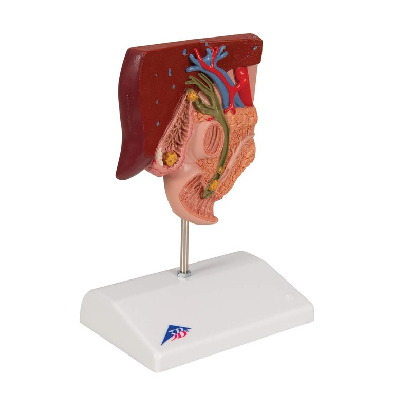 3B Scientific Human Anatomy - Gallstone Model + Free Anatomy