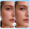 Hydrocolloid Acne Pimple Patches - 640 Count with Tea Tree