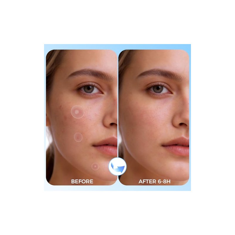 Hydrocolloid Acne Pimple Patches - 640 Count with Tea Tree