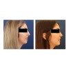 Nose Up Respingador Corrector Nariz Endereza Levanta Perfila Eficaz