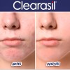 Crema Clearasil Tratameinto Manchas Acne Peroxido Benzoilo Todo Tipo De