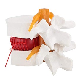 1: 1.5 Modelo de Demostración Médica de Columna Vertebral Lumbar Modelo de Hernia de Disco Lumbar Humano Modelo de Hernia de Disco Lumbar de Columna M