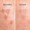 Rael- Parches para el acné, Miracle Microcrystal Spot Cover -