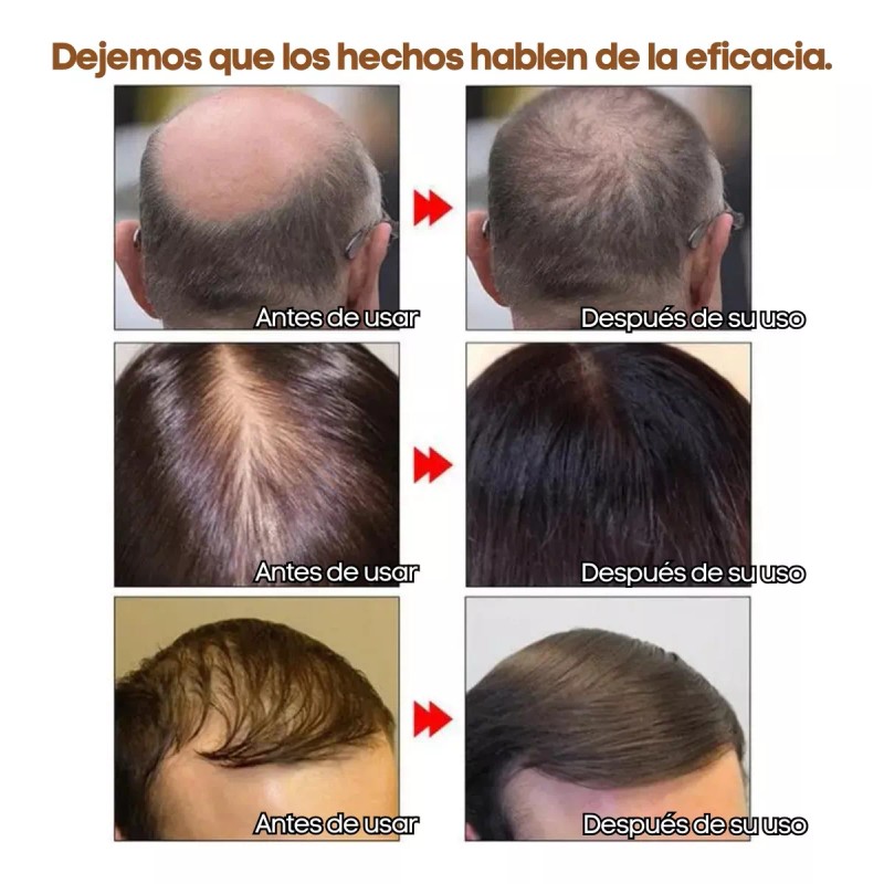 Andrea Paquete 5pza Andrea Solución Crecimiento Del Cabello Full