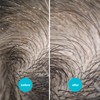 NitWits All-in-One Head Lice Treatment Spray, Kills Lice, Super Lice