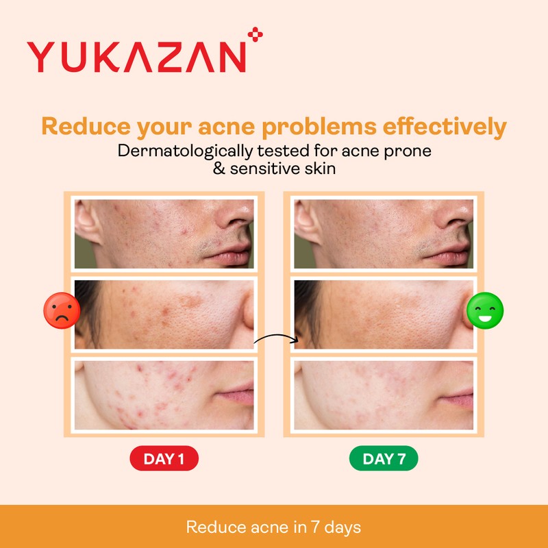 Yukazan Derma Refining Cream Acne & Pore 30ml Acne Removal