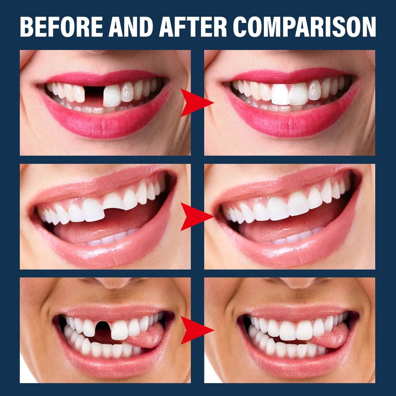 Tooth Repair Kit - Temporary Fake Teeth Replacement Kit with