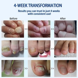 Sefudun Natural Plant Drops for Nails Care Tea Tree and Oregano Oil fo Toenail Nail Care