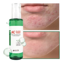 Eyenlip tnico coreano antiacn, suave con la piel sensible                                                                                             