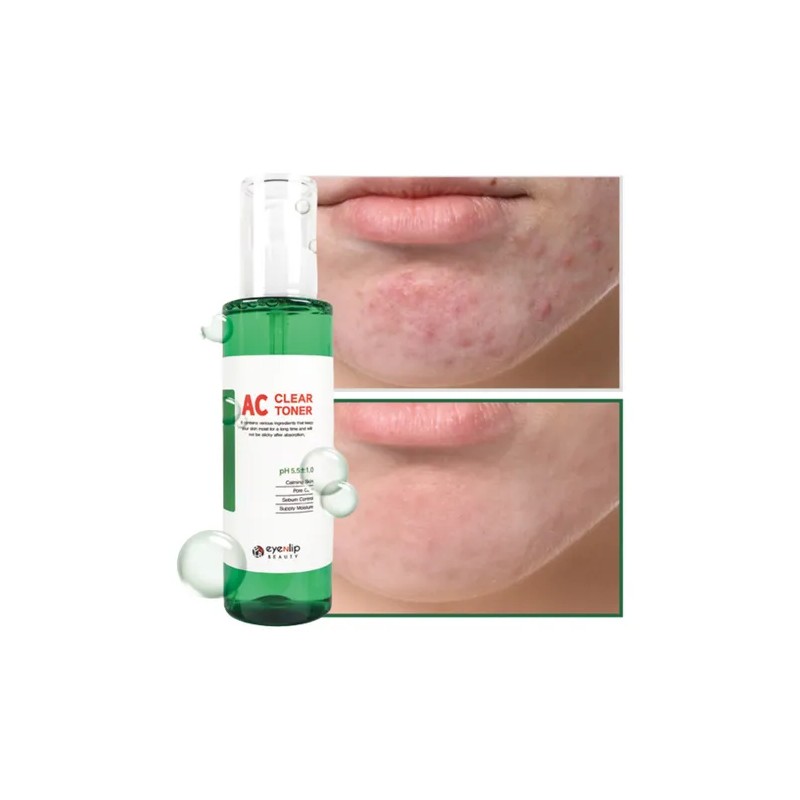 Eyenlip tnico coreano antiacn, suave con la piel sensible