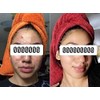 Kit anti-acné Sheló NABEL - Limpia y cuida tu rostro