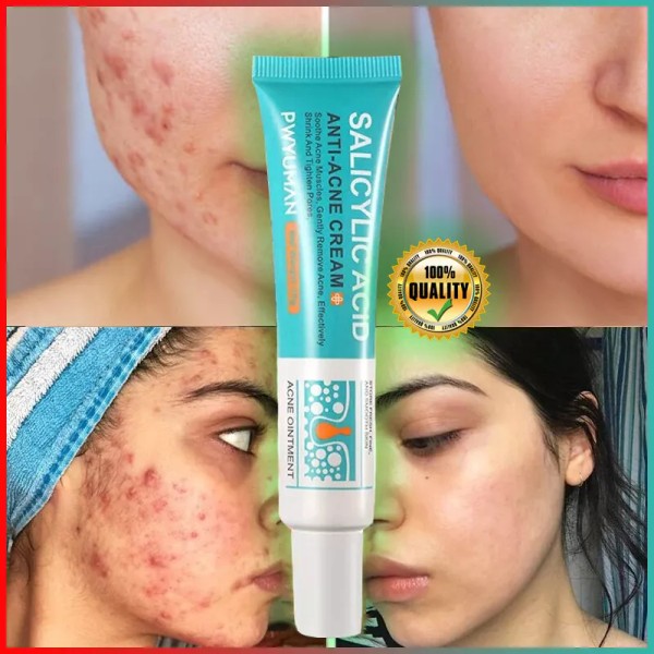 Salicylic Acid Acne Treatment Face Cream for Pimple Spots, Deep