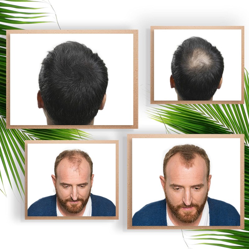 vidalforce KERATINA Fibres to conceal the Baldness – 27.5 Gr