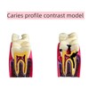 6 Times Dental Caries Model Teaching Typodont Tool for Dentists,