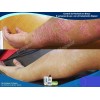 Pomada Nopsor Aux En El Tx De Psoriasis