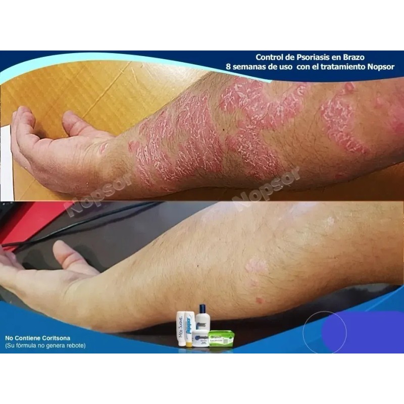 Pomada Nopsor Aux En El Tx De Psoriasis