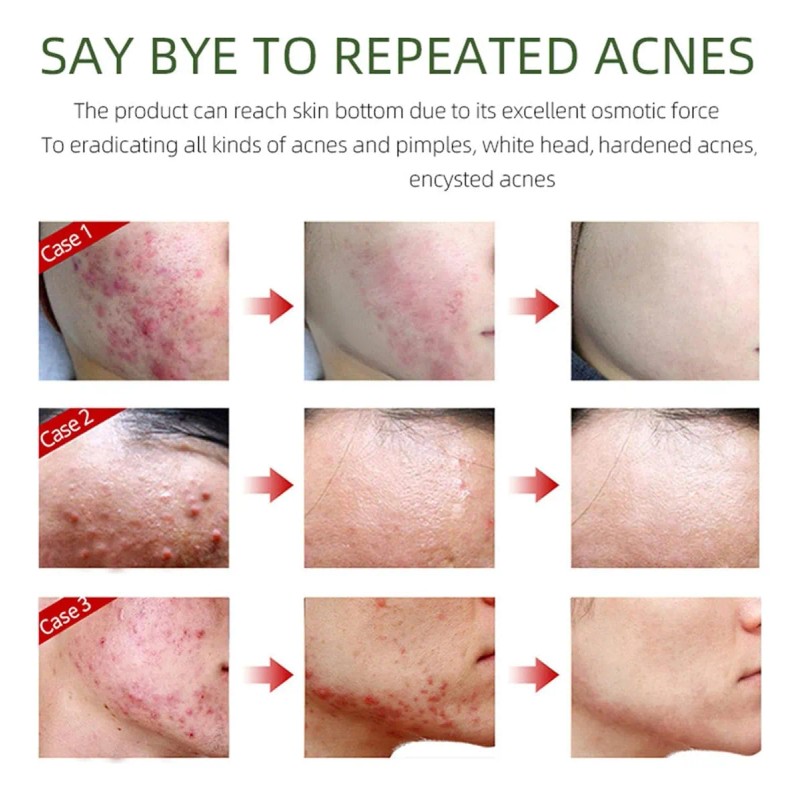 Crema Facial Para Eliminar El Acné, Ingredientes Naturales E