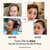 ATHALIA Hair Growth Essence FAST & EFFECTIVE [ Anti-Hair Loss,
