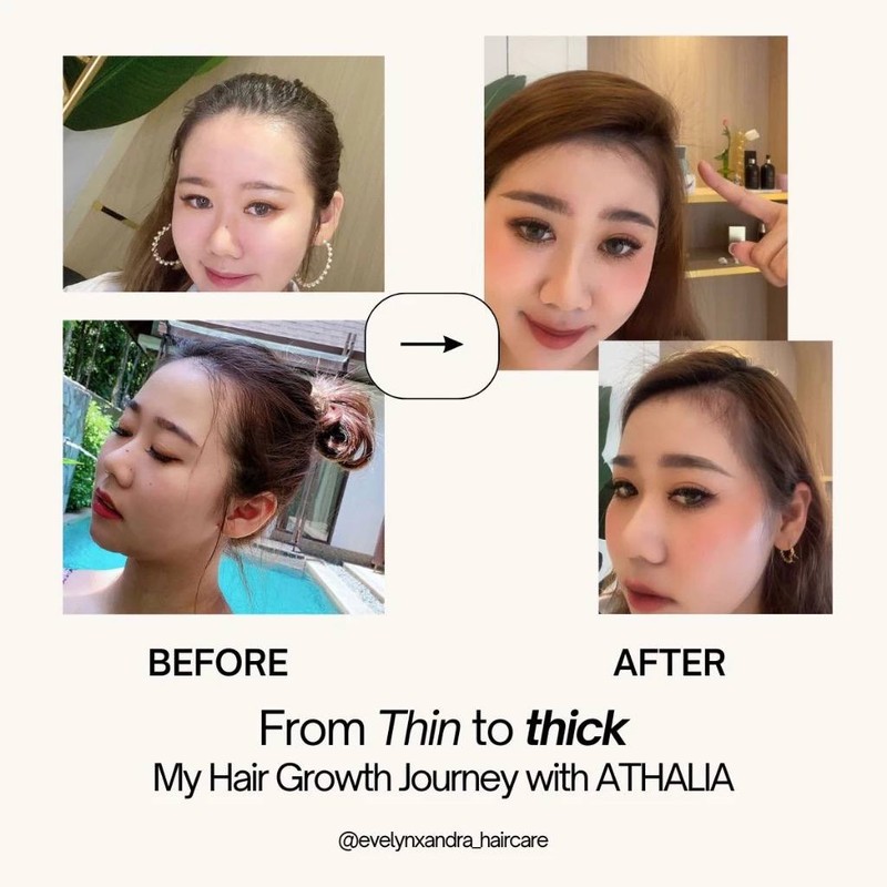 ATHALIA Hair Growth Essence FAST & EFFECTIVE [ Anti-Hair Loss,