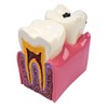 Sarini Tooth Model, Caries Comparative Study Model,Dentist Dental Anatomy Educational