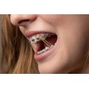 500 Pcs Orthodontic Elastic Rubber Bands, 3.5 Ounces Heavy Dental