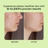 A-Cute Derm B-Kleer Cleansing Gel Acne Cleanser that Purify and