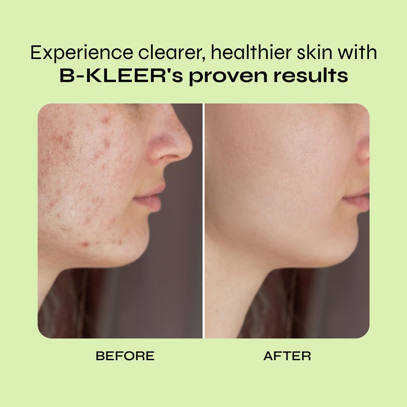A-Cute Derm B-Kleer Cleansing Gel Acne Cleanser that Purify and