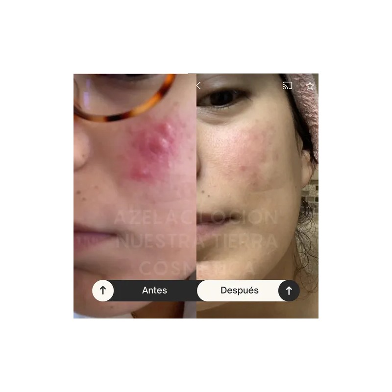 Kit Para Acné Hormonal Shampoo, Azelac Lotion, Gel Y Loción