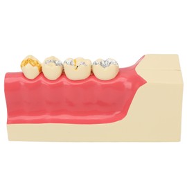 Right Lower Posterior Tooth Model 2X Magnification Detachable Resin Tooth Display Model