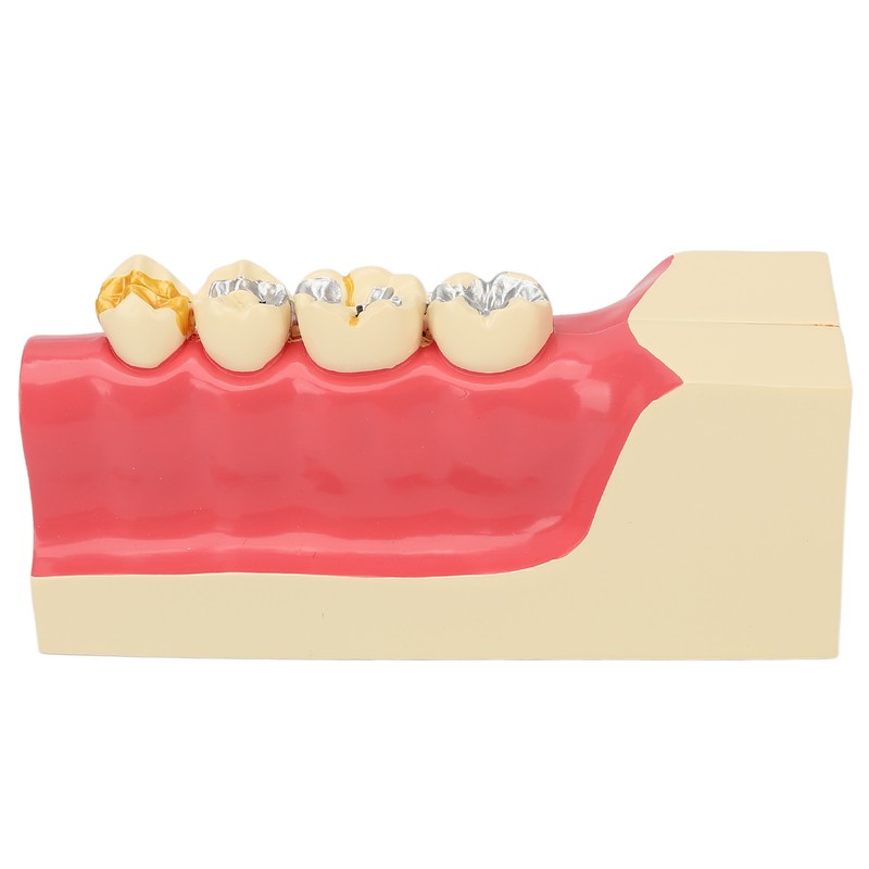 Right Lower Posterior Tooth Model 2X Magnification Detachable Resin Tooth