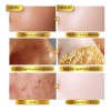 Gel Facial Puntos Negros Espinillas
