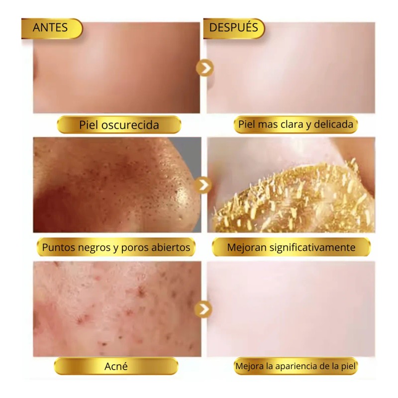 Gel Facial Puntos Negros Espinillas
