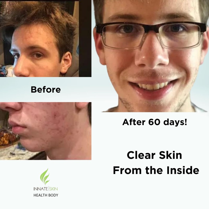 Clear Skin Acne Vitamin System | 20 Antioxidants, Botanicals &