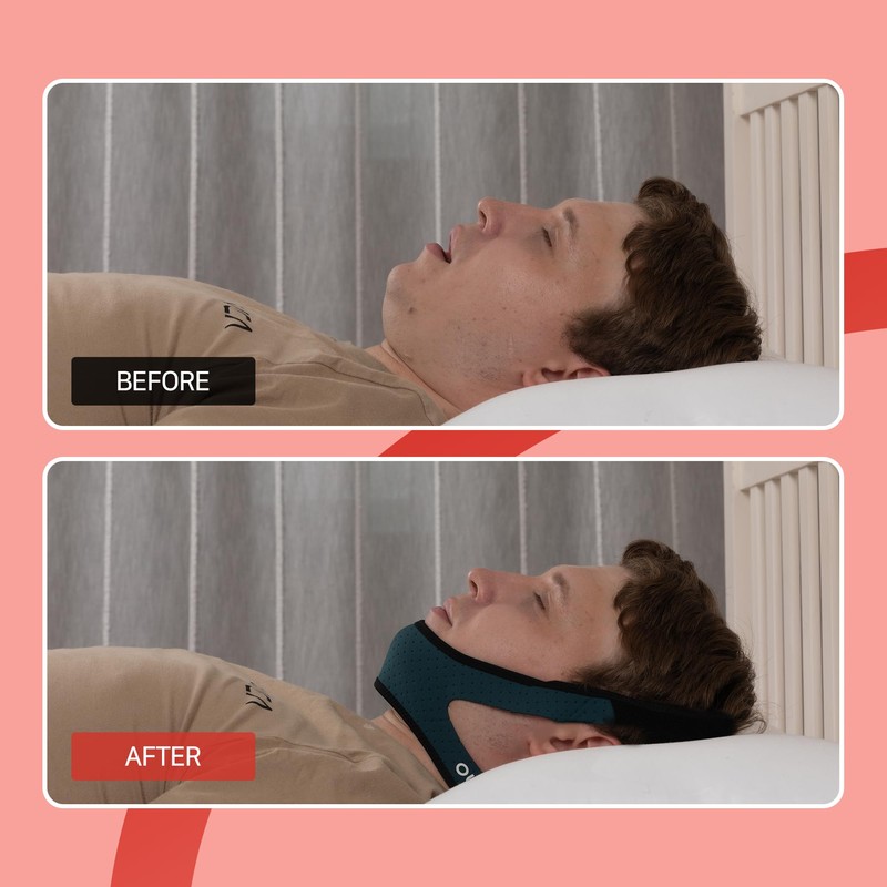 OLG Snore Stopper Chin Strap for Men CPAP Compatible Jaw