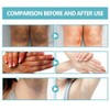 Bluemega Crema Acantosis Nigricans Loción Corporal Hidratante