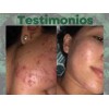 Crema Facial /piel Grasa/suero/acné Y Jabón Tea Tree Farmasi