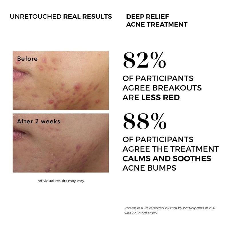 Tratamiento Del Acné, Almohadillas Para El Acné Que Contiene