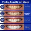 Teeth Whitening, Teeth Whitening Strips: 28 strips of Whitening Kits