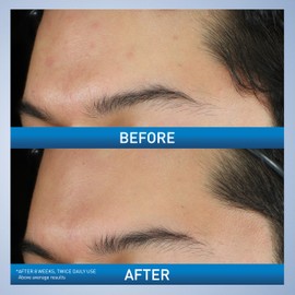 CeraVe Acne Foaming Cream Wash, Gentle Face and Body Cleanser with Benzoyl Peroxide 10%, Hyaluronic Acid, and Niacinamide, 10% Benzoyl Peroxide Treatment Clears Pimples and Blackheads 5 Oz