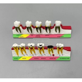 Unbranded Dental Teeth Dentoform Models Caries Disease Periodontal Endodontics Teach Model - Caries + Periodontal