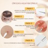 16 piezas – Kit de herramientas para eliminar espinillas y