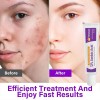 Suero Facial Con Ácido Azelaico 12% Niacinamida Y Vitamina C