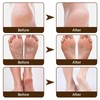 Urea 40% Foot Cream,Foot Cream for Cracked Heels and Dry