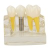 Teeth Implant Model Transparent Dental Teaching Research Demonstration Teeth Model